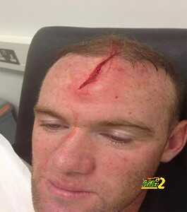 Wayne-Rooney-Injury